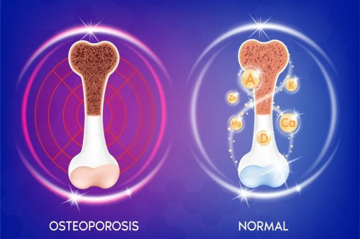 Dr shekhar Reddy Osteoporosis Pain Treatment